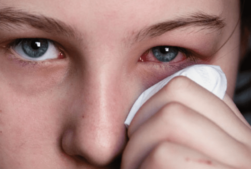 Вос­па­ле­ние ро­го­ви­цы гла­за (ке­ра­ти­ты)