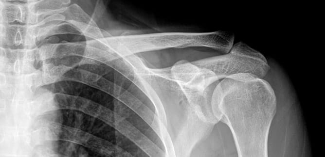 Боль в плечевом суставе: почему возникает и как ее лечить