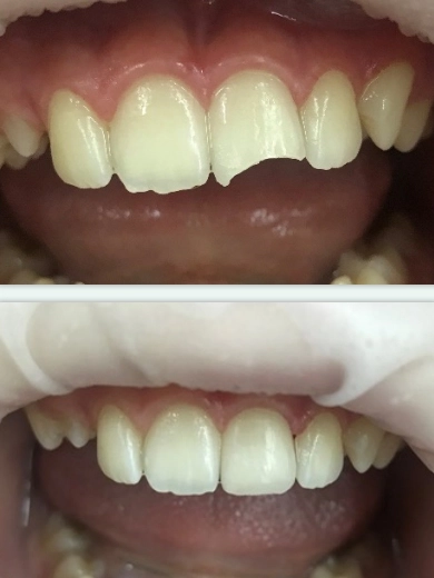 Перелом коронки зуба без повреждения пульпы