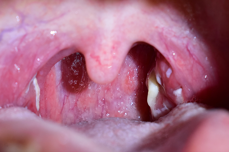 Какие средства для полоскания эффективны при заболеваниях горла?
