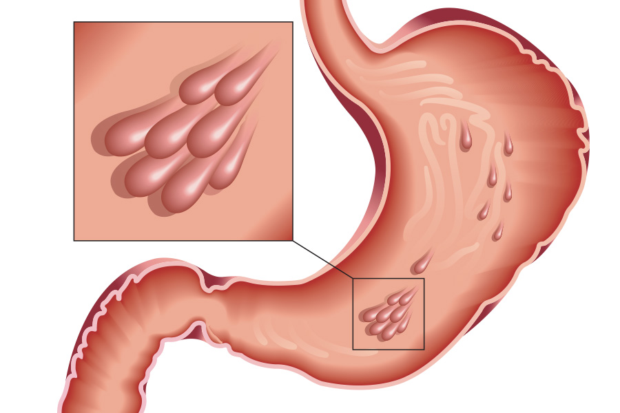 Что такое полипы желудка?