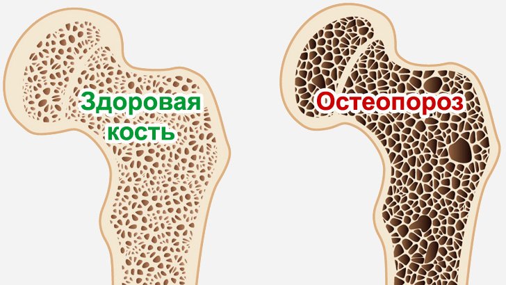 Остеопороз: причины развития, симптомы, лечение и профилактика