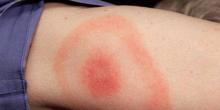 Красные пятна на теле | причины, симптомы, диагностика и лечение бляшек на коже