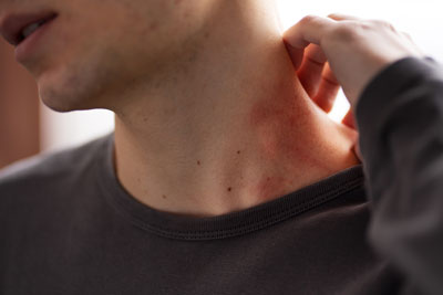 Воспаление лимфоузлов на шее | лечение, симптомы и причины лимфаденита