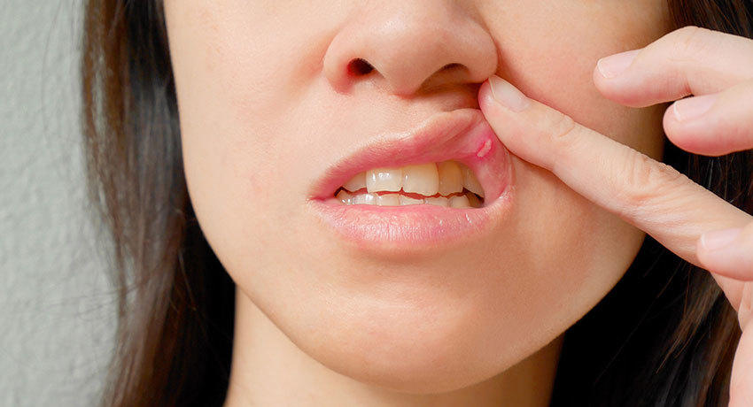 Лечение гемангиомы на губе