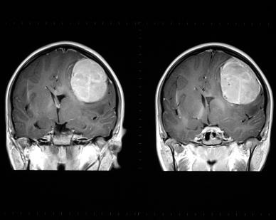 «Рак головного мозга»: редкое заболевание с тяжелыми последствиями