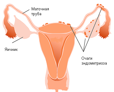 Эндометриоз шейки матки