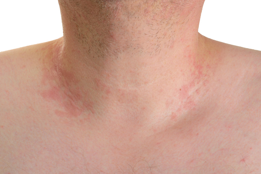 Грибок кожи: симптомы и разновидности