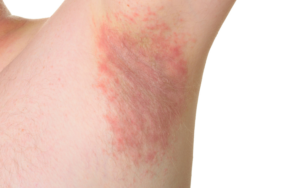 Красные пятна на теле | причины, симптомы, диагностика и лечение бляшек на коже