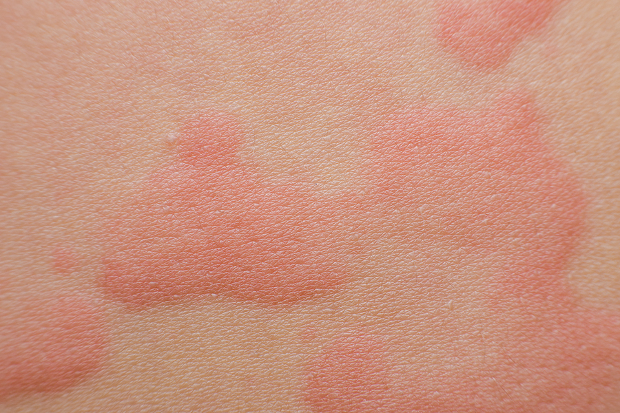 Аллергия на коже у взрослых
